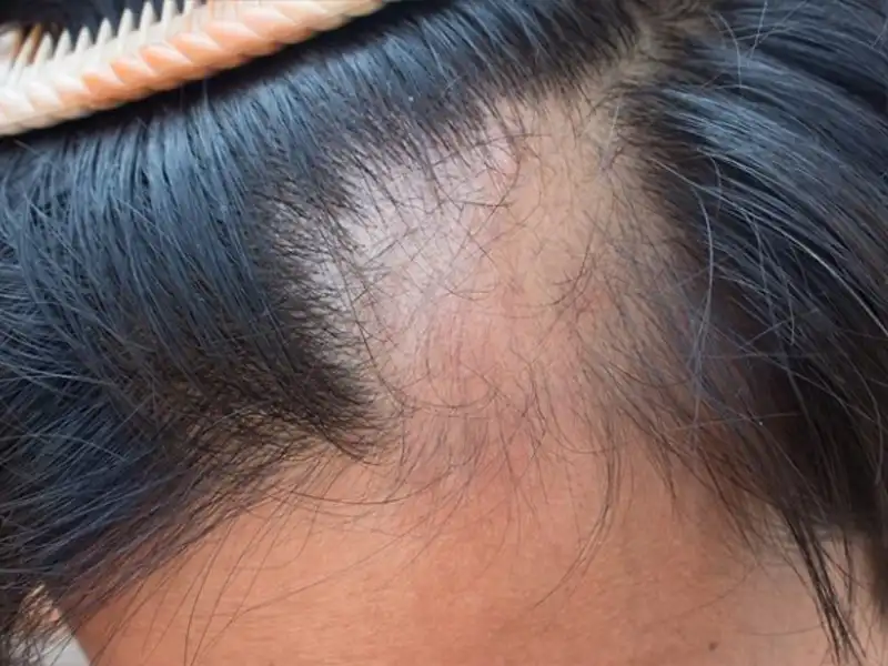 آیا درمان ریزش مو سکهای در زنان با مردان متفاوت است؟