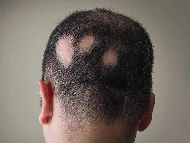 آیا ریزش مو سکهای خطرناک است؟