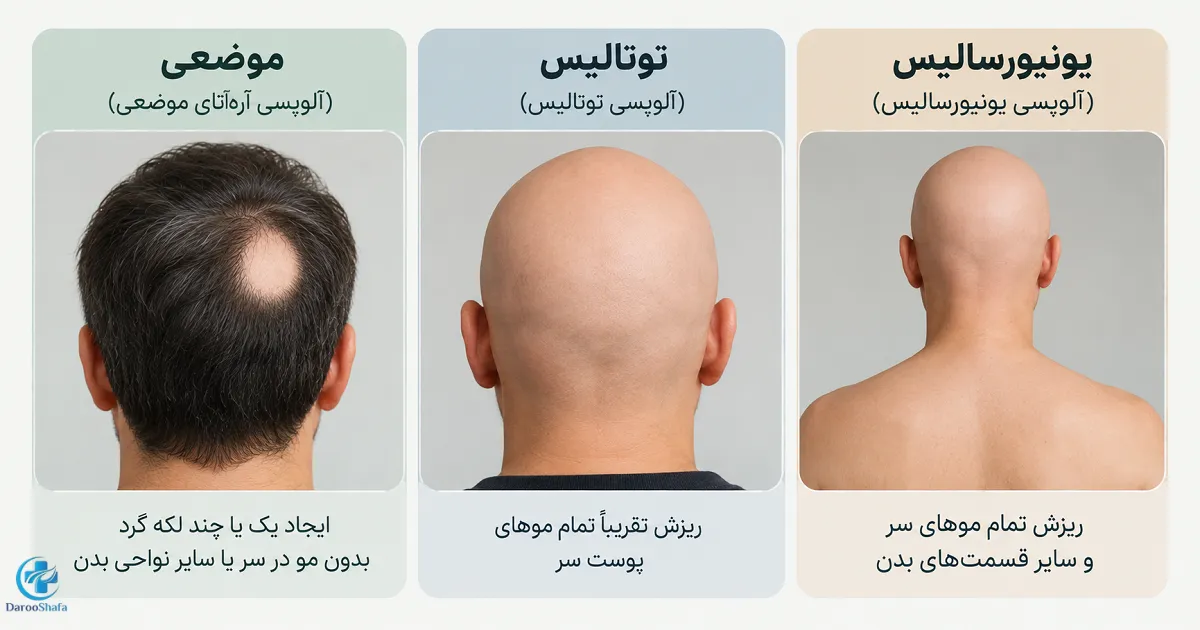 انواع آلوپسی آره آتا؛ موضعی، توتالیس و یونیورسالیس