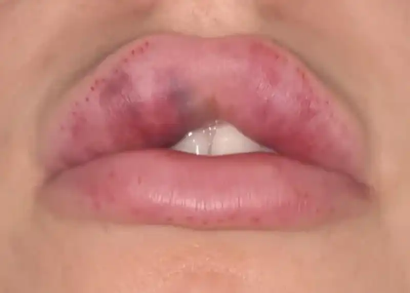 تورم و کبودی ناشی از عفونت کدام است؟