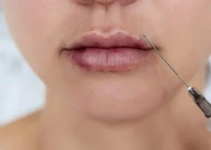 علل کبودی و ورم در ناحیه تزریق ژل