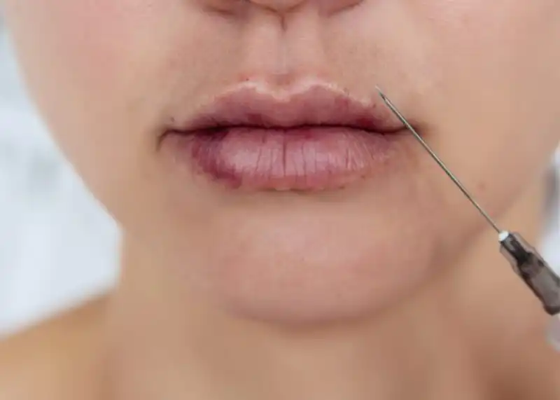 علل کبودی و ورم در ناحیه تزریق ژل