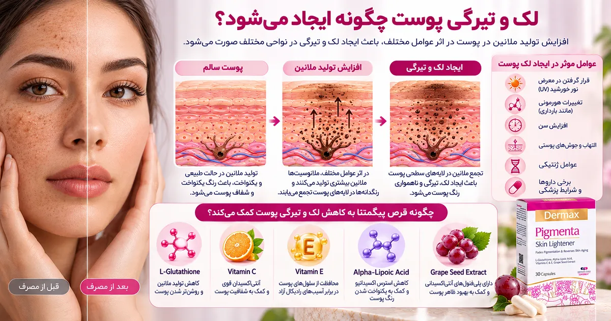 تصویر شماتیک لک صورت و هایپرپیگمانتاسیون و افزایش رنگدانه‌ های پوستی