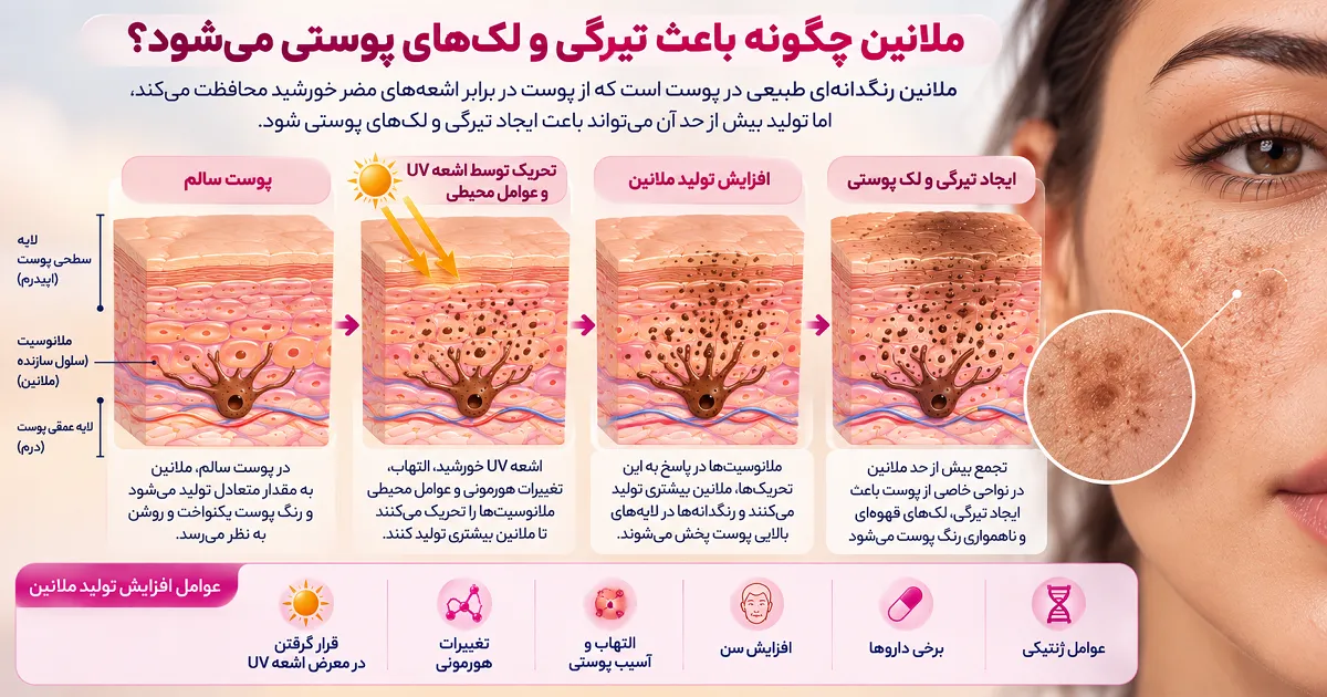 تصویر نحوه افزایش تولید ملانین و ایجاد لک و تیرگی در پوست