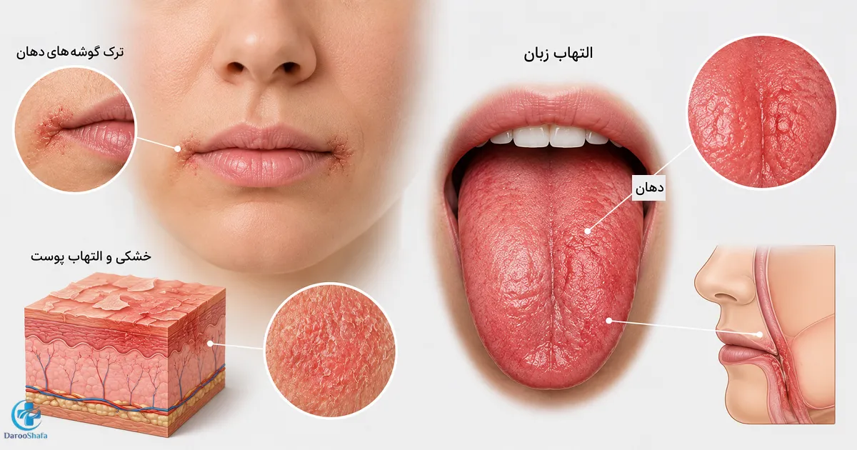 ترک گوشه دهان، التهاب زبان و خشکی و التهاب پوست از علائم احتمالی کمبود ویتامین B6