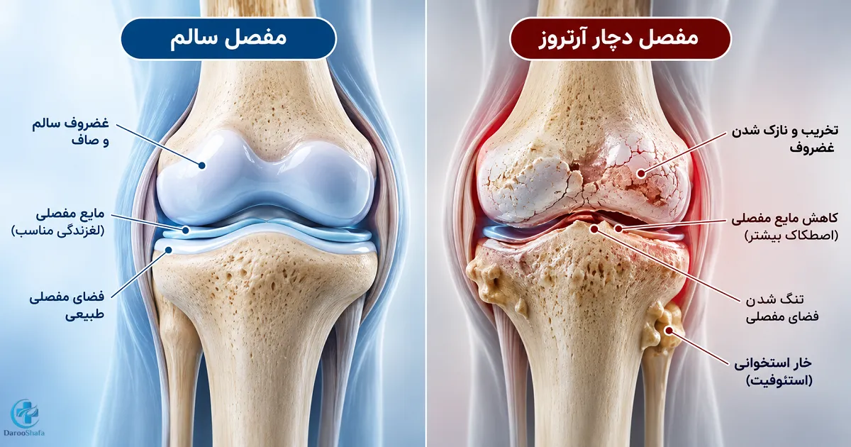 مقایسه غضروف و فضای مفصلی در زانوی سالم و زانوی مبتلا به آرتروز