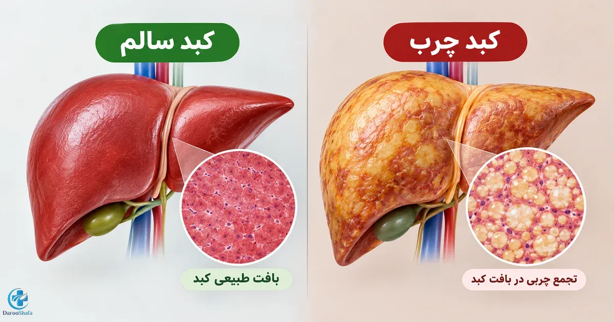 تصویر شماتیک مقایسه کبد سالم با کبد چرب و تجمع چربی در سلول های کبدی